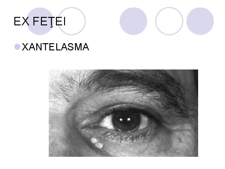 EX FEŢEI l XANTELASMA EX FEŢEI l XANTELASMA