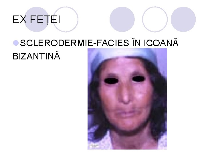 EX FEŢEI l SCLERODERMIE-FACIES ÎN ICOANĂ BIZANTINĂ EX FEŢEI l SCLERODERMIE-FACIES ÎN ICOANĂ BIZANTINĂ