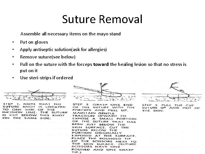 Suture Removal Assemble all necessary items on the mayo stand • • • Put