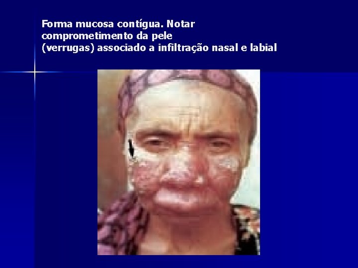 Forma mucosa contígua. Notar comprometimento da pele (verrugas) associado a infiltração nasal e labial Forma mucosa contígua. Notar comprometimento da pele (verrugas) associado a infiltração nasal e labial