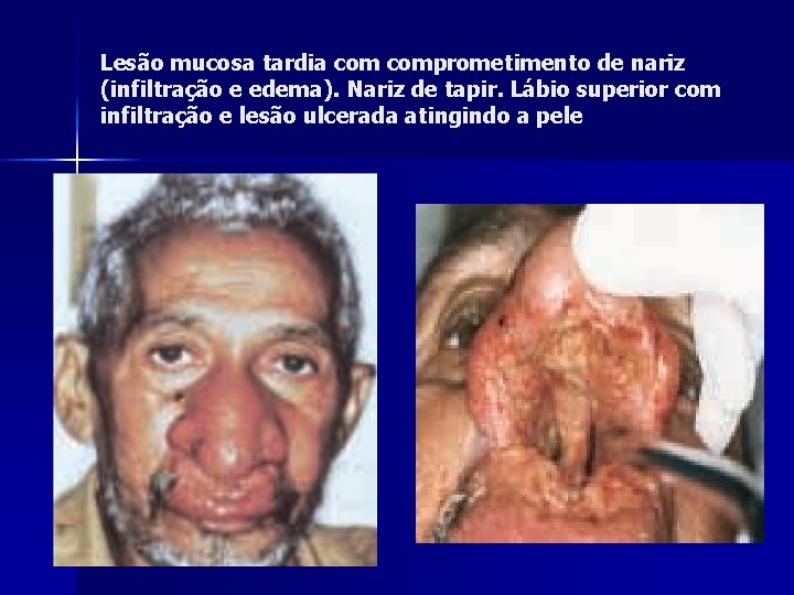 Lesão mucosa tardia comprometimento de nariz (infiltração e edema). Nariz de tapir. Lábio superior