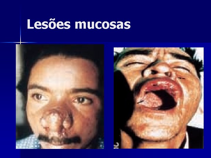 Lesões mucosas 