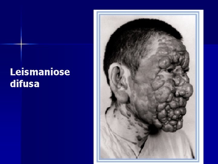 Leismaniose difusa Leismaniose difusa