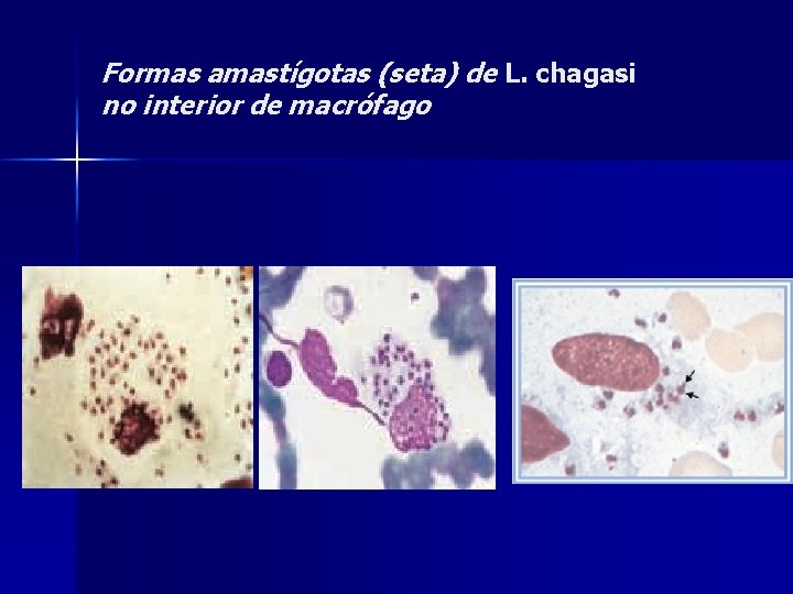 Formas amastígotas (seta) de L. chagasi no interior de macrófago 