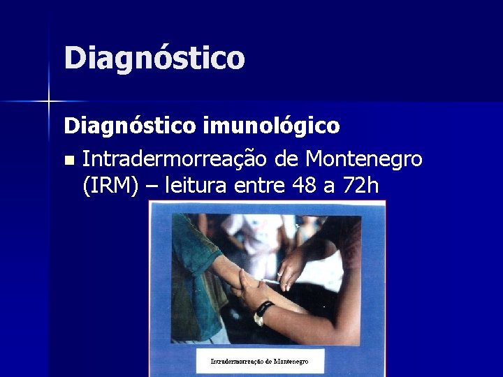 Diagnóstico imunológico n Intradermorreação de Montenegro (IRM) – leitura entre 48 a 72 h Diagnóstico imunológico n Intradermorreação de Montenegro (IRM) – leitura entre 48 a 72 h