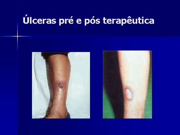 Úlceras pré e pós terapêutica Úlceras pré e pós terapêutica