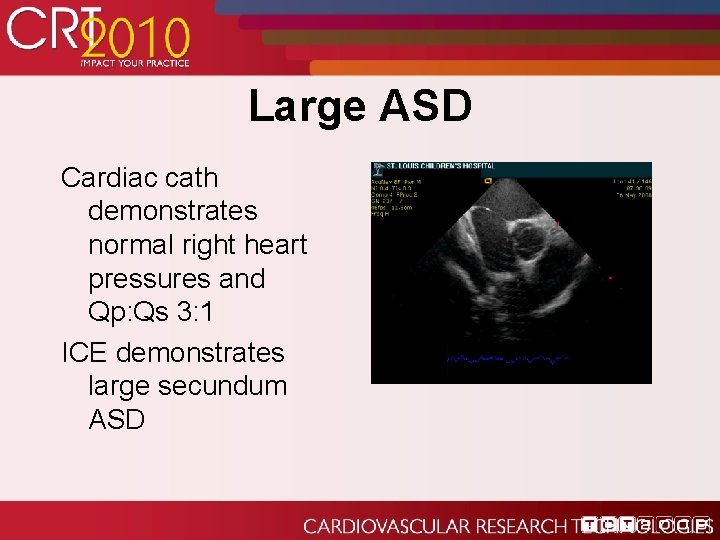 Large ASD Cardiac cath demonstrates normal right heart pressures and Qp: Qs 3: 1