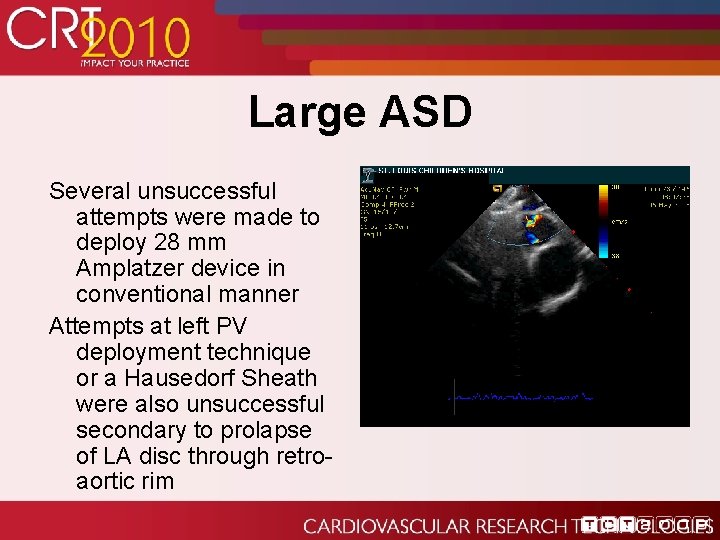 Large ASD Several unsuccessful attempts were made to deploy 28 mm Amplatzer device in