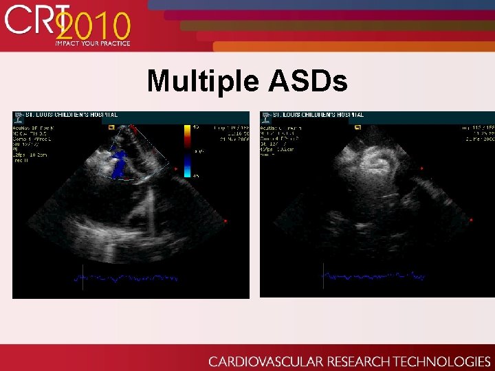 Multiple ASDs 