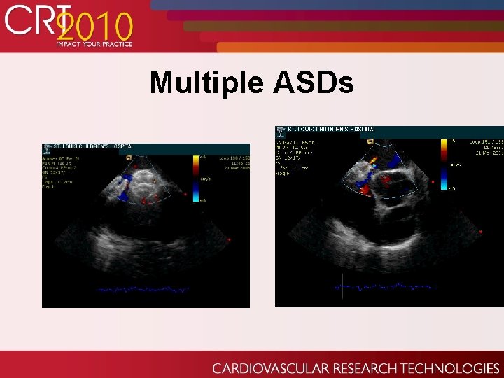 Multiple ASDs 