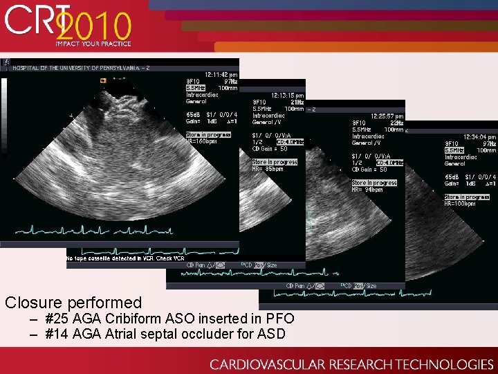 Closure performed – #25 AGA Cribiform ASO inserted in PFO – #14 AGA Atrial