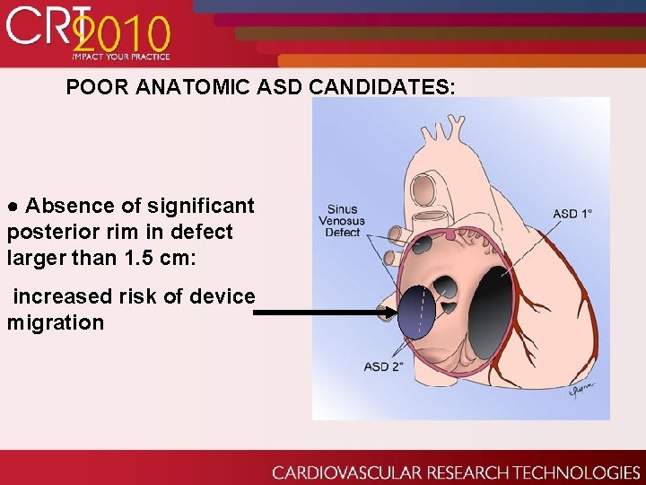 POOR ANATOMIC ASD CANDIDATES: ● Absence of significant posterior rim in defect larger than