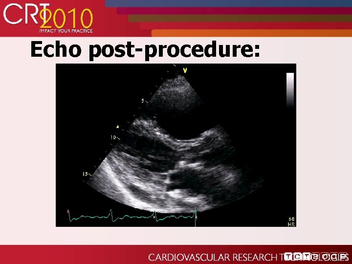 Echo post-procedure: 