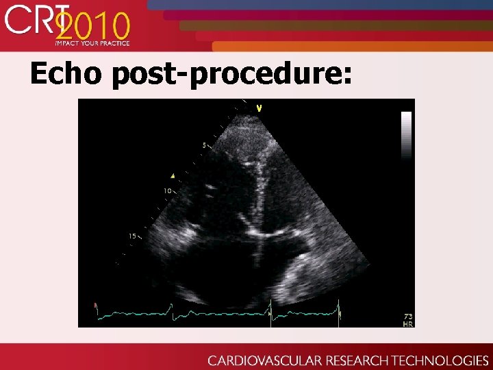 Echo post-procedure: 