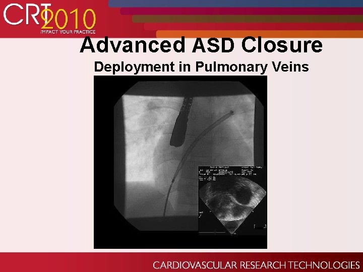 Advanced ASD Closure Deployment in Pulmonary Veins 