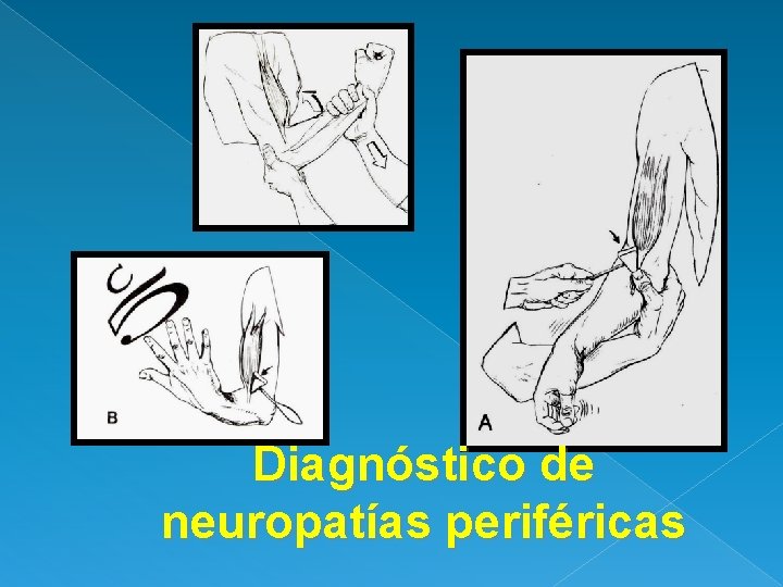 Diagnóstico de neuropatías periféricas 