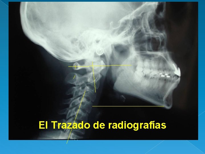 El Trazado de radiografías 
