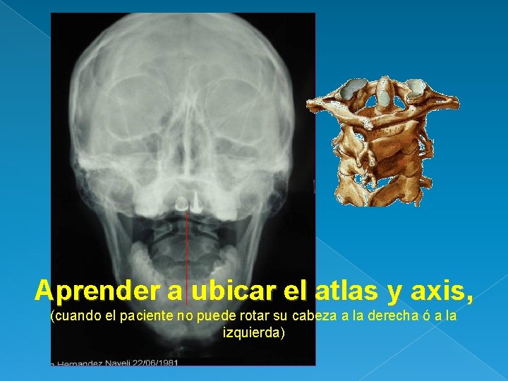 Aprender a ubicar el atlas y axis, (cuando el paciente no puede rotar su