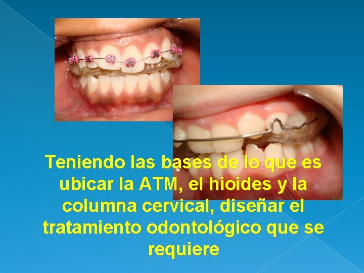 Teniendo las bases de lo que es ubicar la ATM, el hioides y la