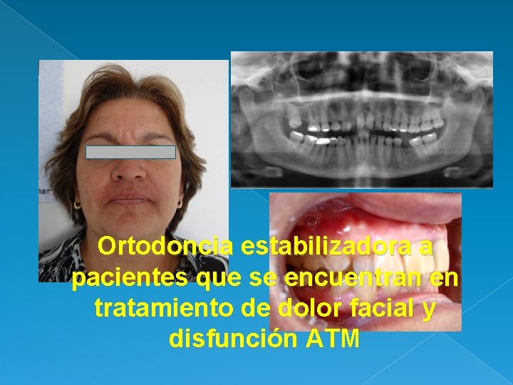 Ortodoncia estabilizadora a pacientes que se encuentran en tratamiento de dolor facial y disfunción