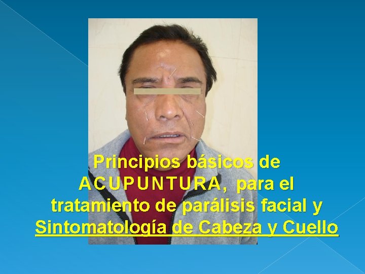 Principios básicos de ACUPUNTURA, para el tratamiento de parálisis facial y Sintomatología de Cabeza