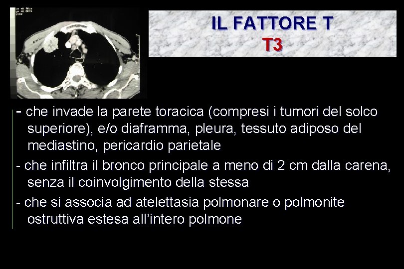 IL FATTORE T T 3 - che invade la parete toracica (compresi i tumori