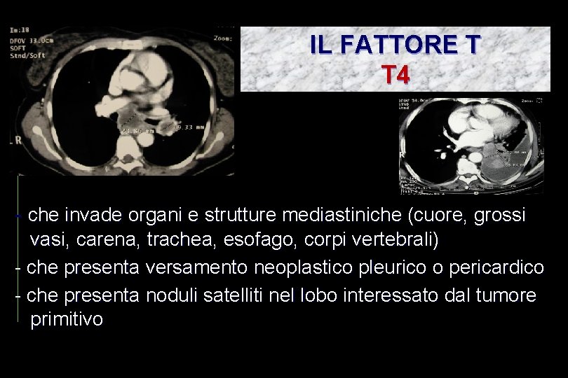 IL FATTORE T T 4 - che invade organi e strutture mediastiniche (cuore, grossi