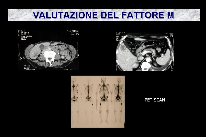 VALUTAZIONE DEL FATTORE M PET SCAN 