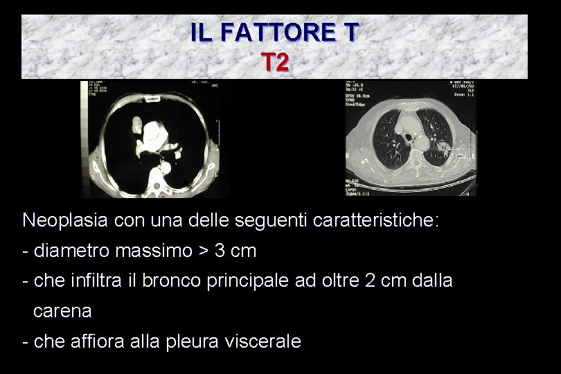 IL FATTORE T T 2 Neoplasia con una delle seguenti caratteristiche: - diametro massimo