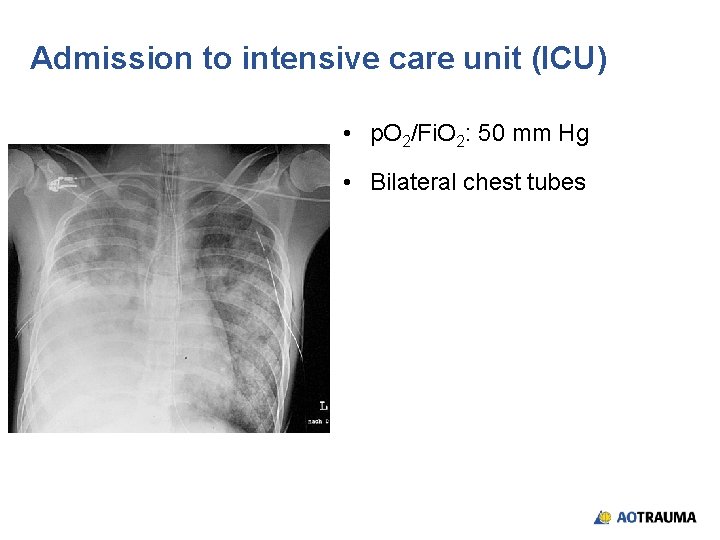 Admission to intensive care unit (ICU) • p. O 2/Fi. O 2: 50 mm