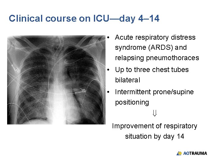 Clinical course on ICU—day 4– 14 • Acute respiratory distress syndrome (ARDS) and relapsing
