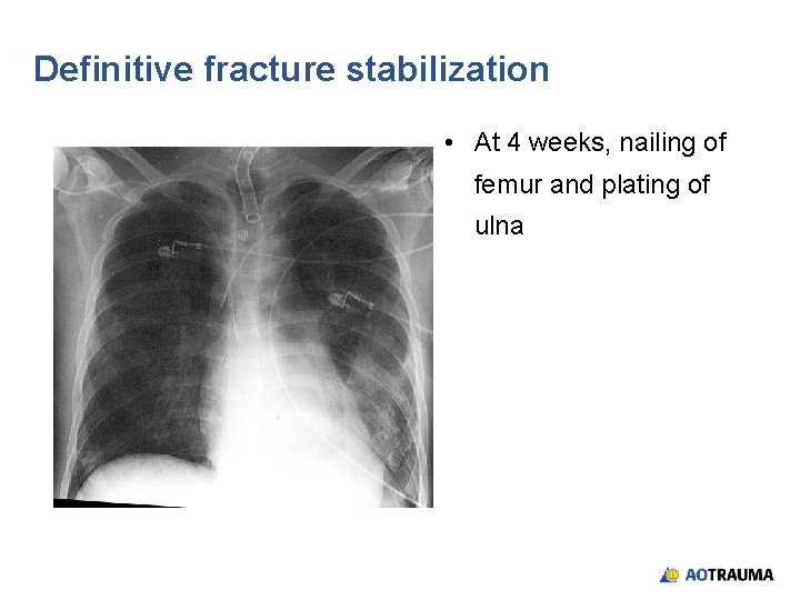 Definitive fracture stabilization • At 4 weeks, nailing of femur and plating of ulna