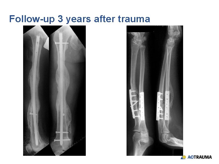 Follow-up 3 years after trauma 