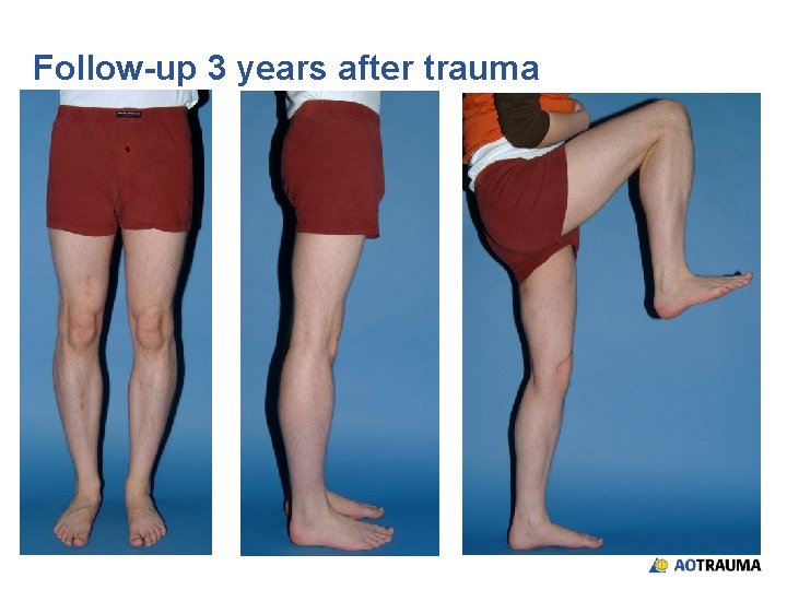 Follow-up 3 years after trauma 