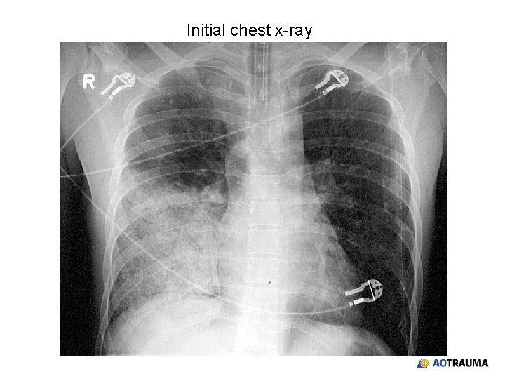 Initial chest x-ray 