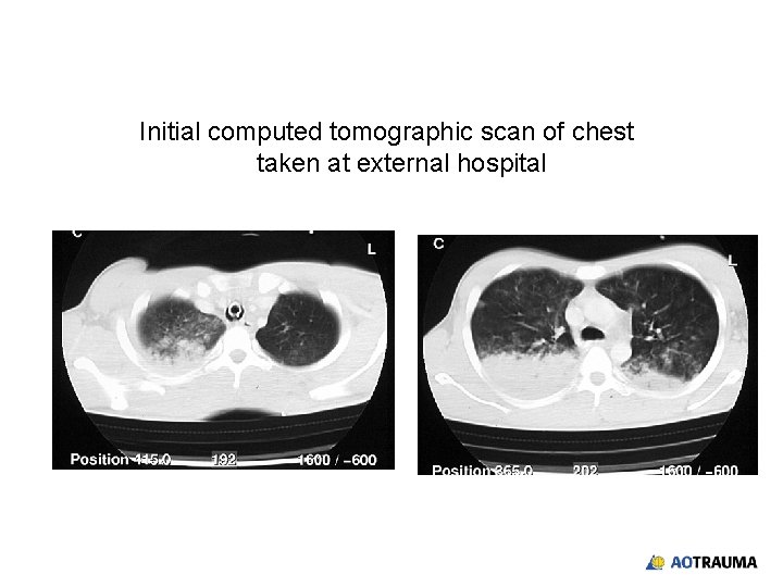 Initial computed tomographic scan of chest taken at external hospital 