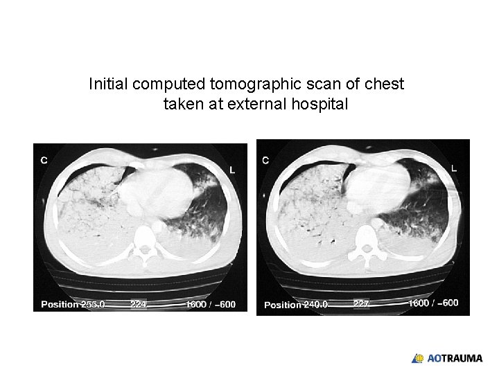 Initial computed tomographic scan of chest taken at external hospital 