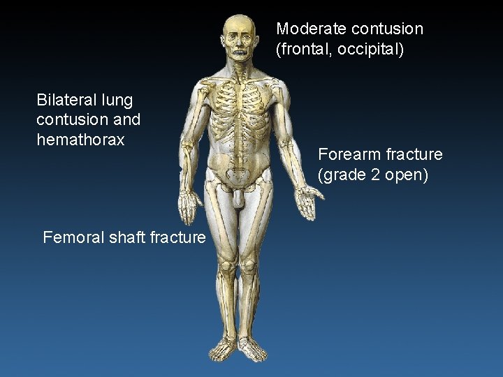 Diagnosis: Bilateral lung contusion and hemathorax Femoral shaft fracture Moderate contusion (frontal, occipital) Forearm