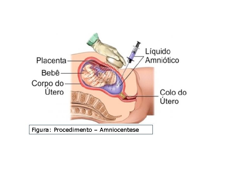 Figura: Procedimento – Amniocentese 