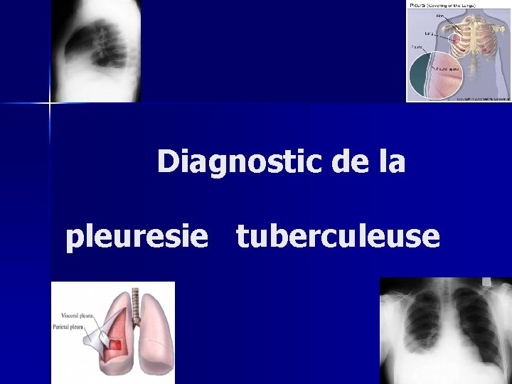  Diagnostic de la pleuresie tuberculeuse 