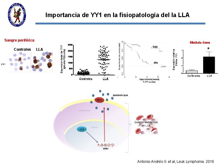 Importancia de YY 1 en la fisiopatología del la LLA Sangre periférica Expresión relativa