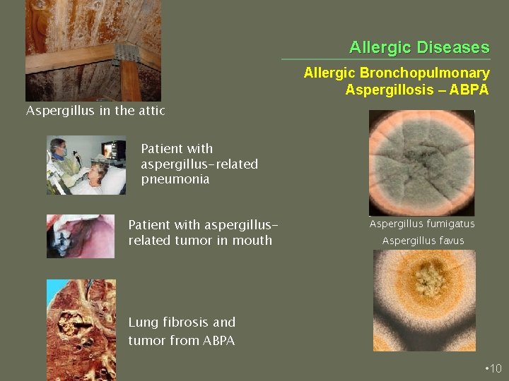 Allergic Diseases Allergic Bronchopulmonary Aspergillosis – ABPA Aspergillus in the attic Patient with aspergillus-related