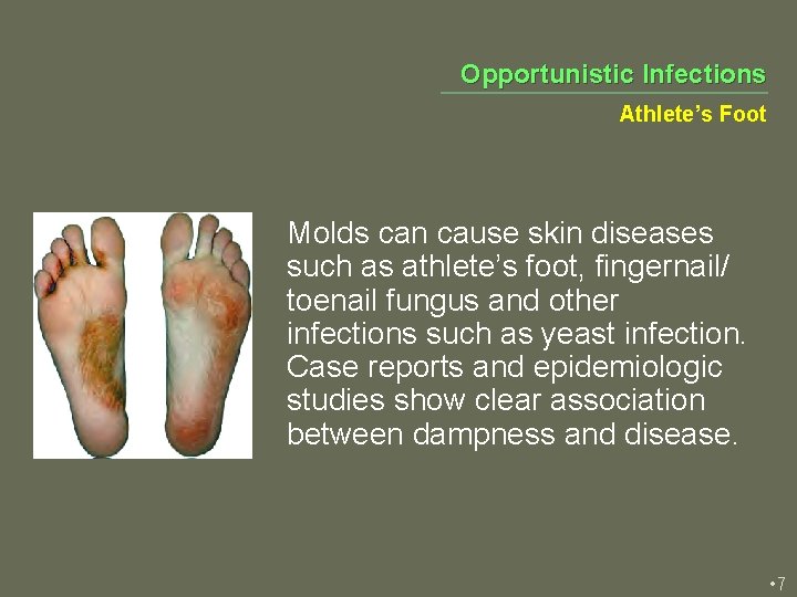 Opportunistic Infections Athlete’s Foot Molds can cause skin diseases such as athlete’s foot, fingernail/