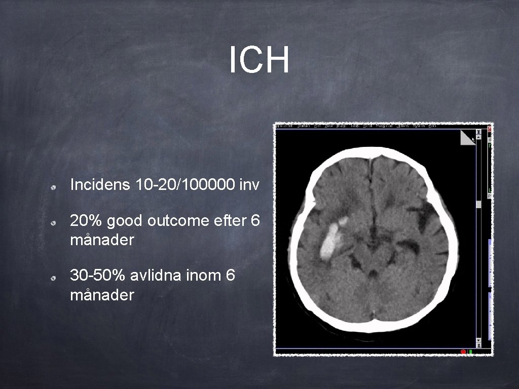 Intracerebrala hematom ICH C Brorsson IVA NUS Hemorrhagisk