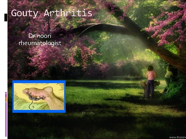 Gouty Arthritis Dr. noori rheumatologist 