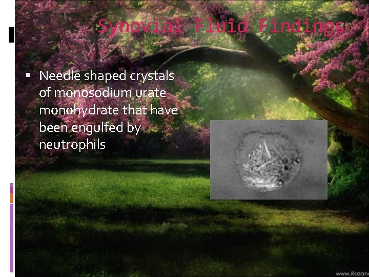 Synovial Fluid Findings Needle shaped crystals of monosodium urate monohydrate that have been engulfed