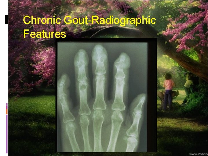 Chronic Gout-Radiographic Features 