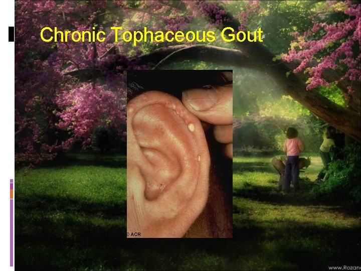 Chronic Tophaceous Gout 