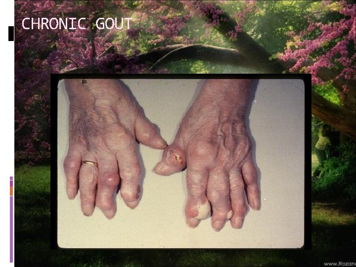 CHRONIC GOUT 