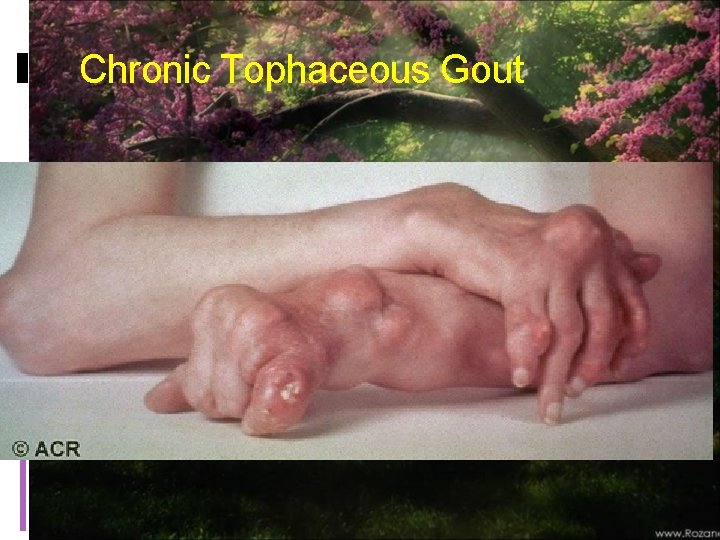 Chronic Tophaceous Gout 